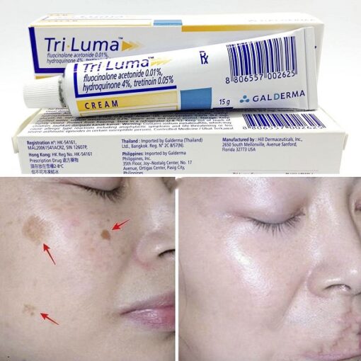 Galderma Tri-Luma Cream là sản phẩm phẩm hỗ trợ giảm thâm nám da lâu năm, tàn nhang