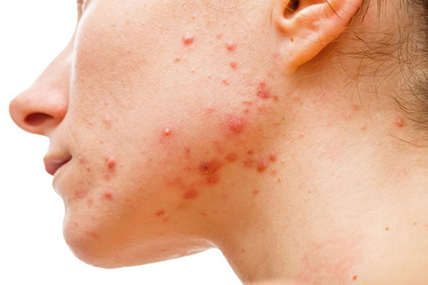 Mụn sưng cứng dưới da thường có dấu hiệu lan rộng nếu không được chữa trị đúng cách