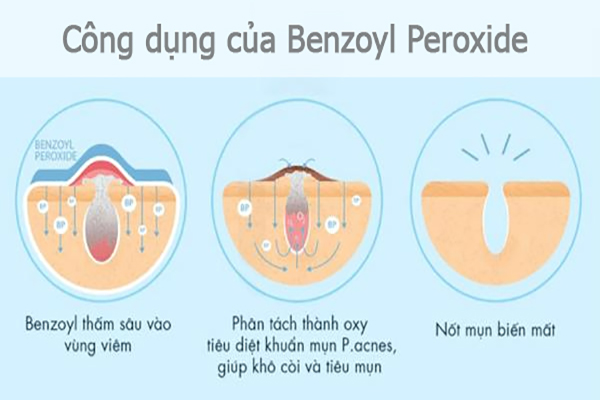 Benzoyl Peroxide thường có trong các sản phẩm trị mụn