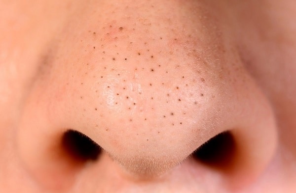 Mụn đầu đen có thể dễ nhận thấy ở trên đầu mũi