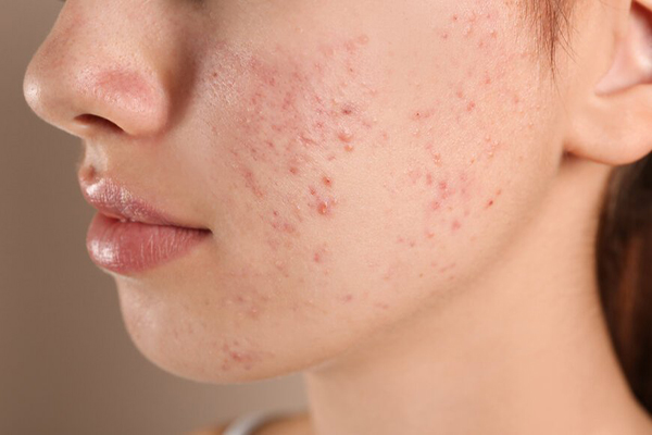 Da mặt nổi nhiều mụn do nhiễm độc corticoid