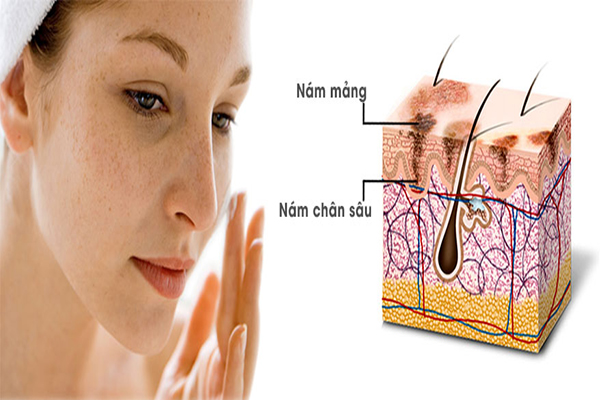 Nám mảng nằm ở tầng ngoài cùng của da nên dễ điều trị hơn