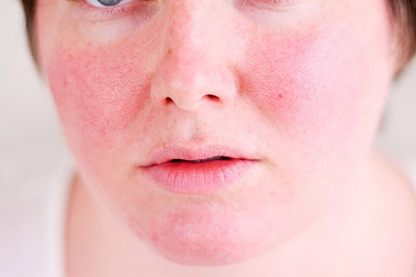 Da mặt sưng đỏ khi các triệu chứng dị ứng nặng hơn